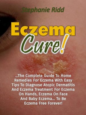 cover image of Eczema Cure!